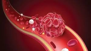 Blood Clots: A Silent Threat Leading to Heart Attack and Stroke.